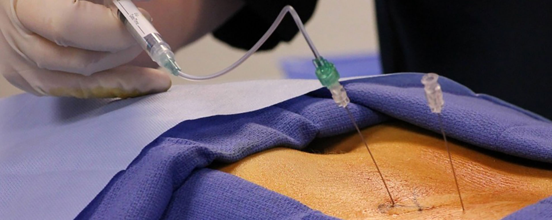 تزریق داروئی اپیدورال